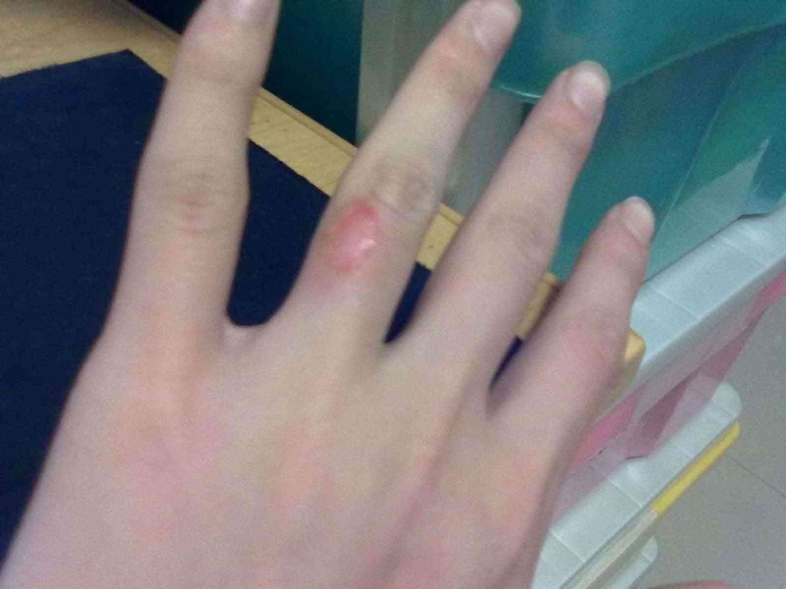 火燙了以后能擦化妝品嗎(火燙了以后能擦化妝品嗎圖片)