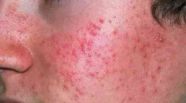 快速修復(fù)化妝品有沒(méi)有激素(快速修復(fù)化妝品有沒(méi)有激素成分)