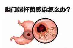 克拉霉素緩釋片說明書(克拉霉素緩釋片說明書明書)