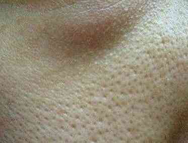 用了化妝品后毛孔粗大(用完護膚品毛孔粗大)