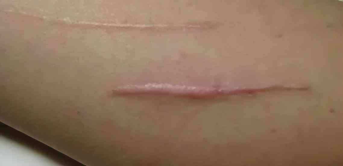 良心國貨化妝品消疤(國貨祛疤膏)插圖8