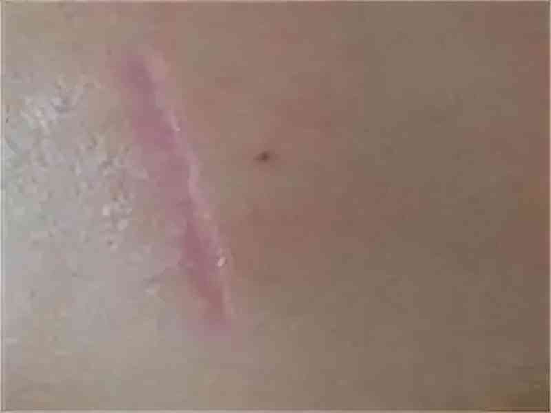 良心國貨化妝品消疤(國貨祛疤膏)插圖9