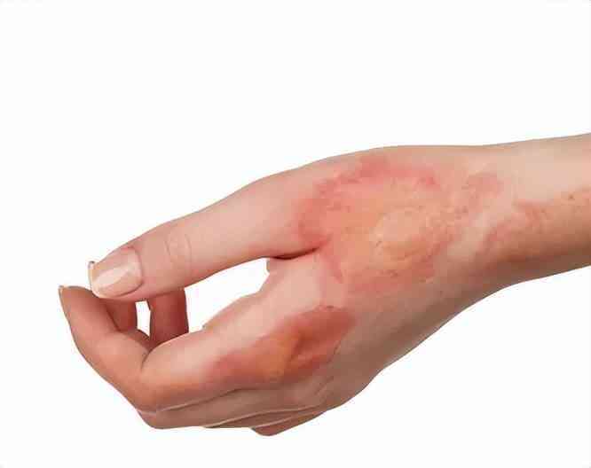 良心國貨化妝品消疤(國貨祛疤膏)插圖10