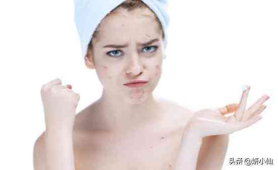 下巴上的粉刺化妝品(下巴粉刺用什么)