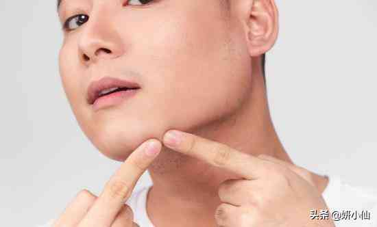 下巴上的粉刺化妝品(下巴粉刺用什么)插圖1