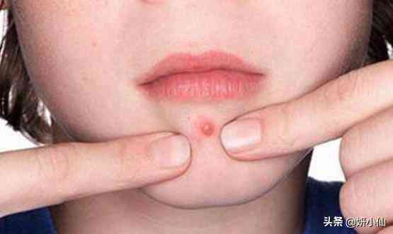 下巴上的粉刺化妝品(下巴粉刺用什么)插圖2