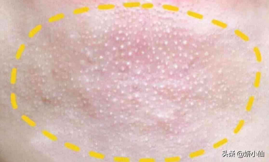 下巴上的粉刺化妝品(下巴粉刺用什么)插圖3