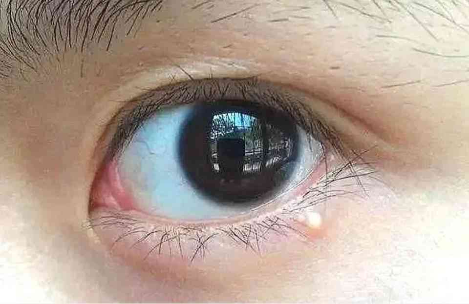 擦化妝品臉長脂肪粒(擦化妝品臉長脂肪粒怎么處理)