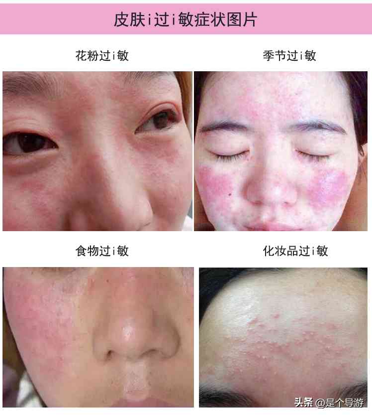 過(guò)敏好了可以擦化妝品(過(guò)敏好了可以擦化妝品嘛)