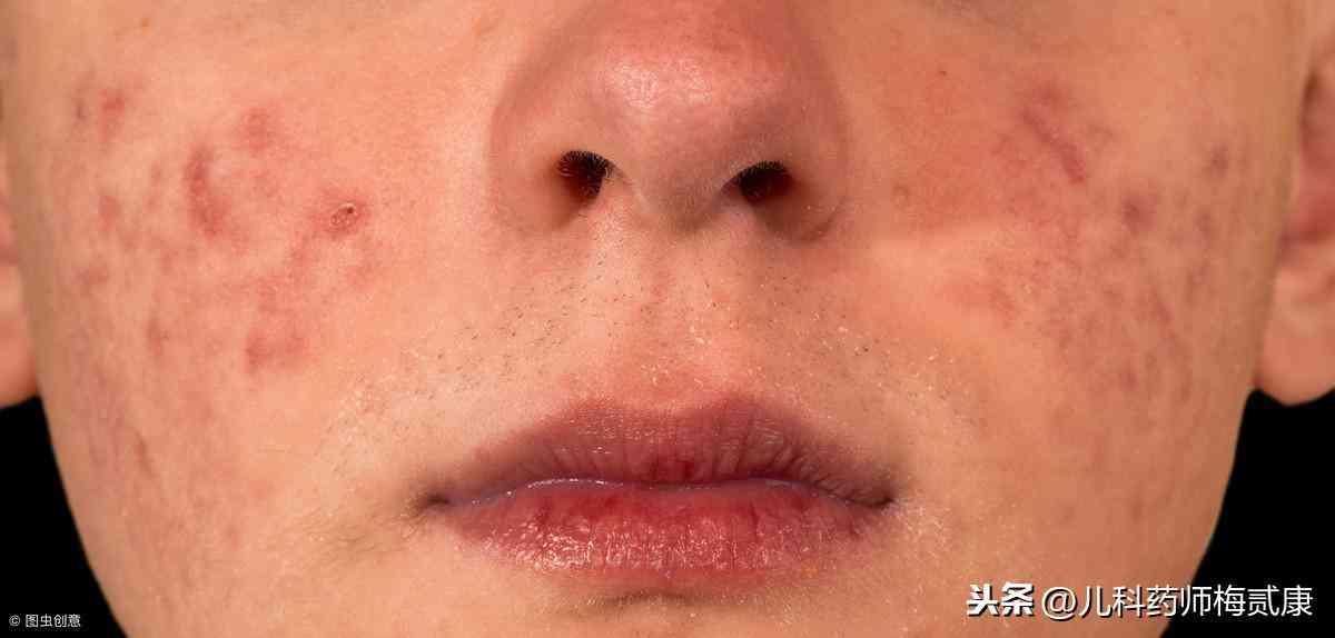 為什么用化妝品會起癬(為什么用化妝品會起癬的原因)