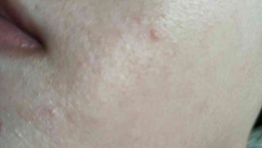 用好化妝品為啥起痘(用好化妝品為啥起痘痘)